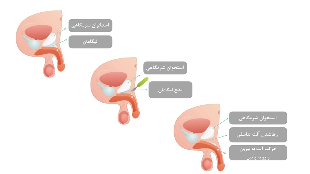 جراحی قطع لیگامان 