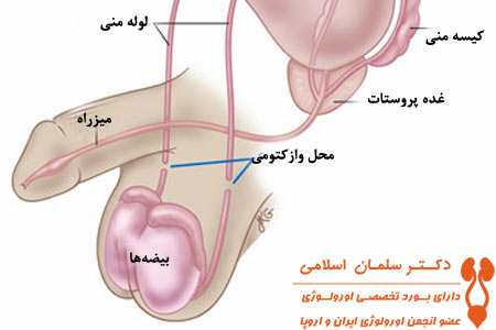 هزینه عمل وازکتومی